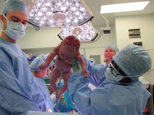 birth interventions caesarean